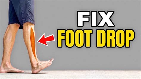 drop-tested to feet|best treatment for drop foot.